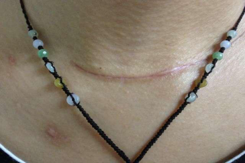 传统手术术后颈部疤痕.png